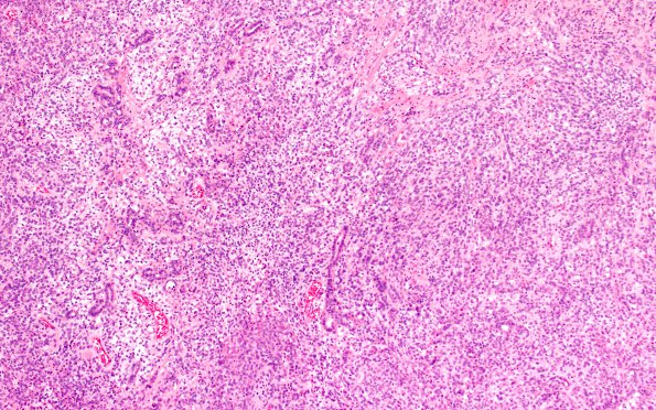 27A2 Meningioma, anaplastic, gland meta (Case 27) H&E 10X