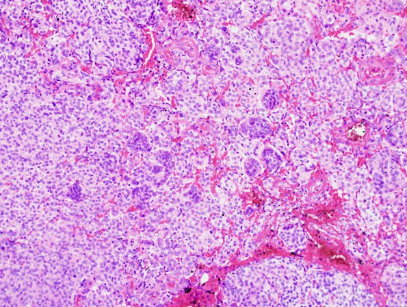 27A3 Meningioma, anaplastic, gland meta (Case 27) first resection 20x.jpg