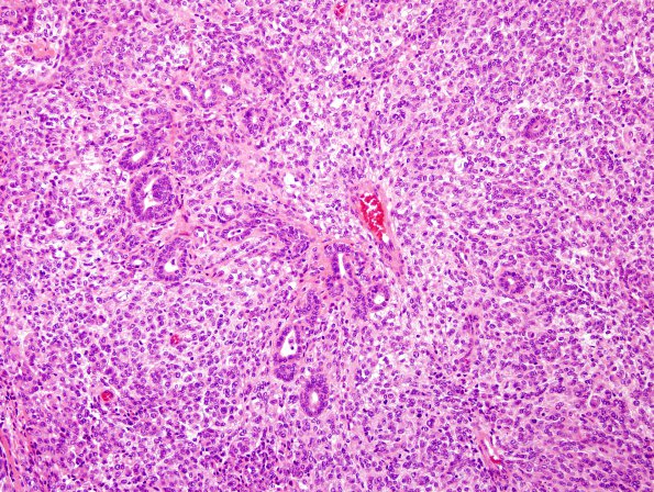 27A5 Meningioma, anaplastic, gland meta (Case 27) H&E 4.jpg