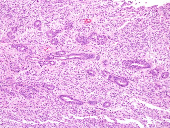 27A6 Meningioma, anaplastic, gland meta (Case 27) 20x.jpg