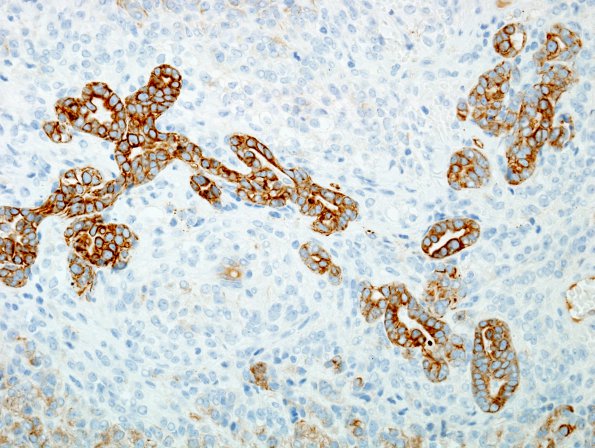 27C4 Meningioma, anaplastic, gland meta (Case 27) CAM5.2 2.jpg