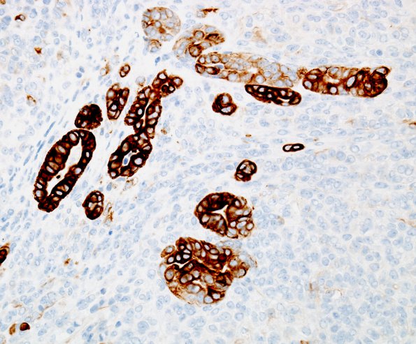 27C6 Meningioma, anaplastic, gland meta (Case 27) CK7 3a.jpg