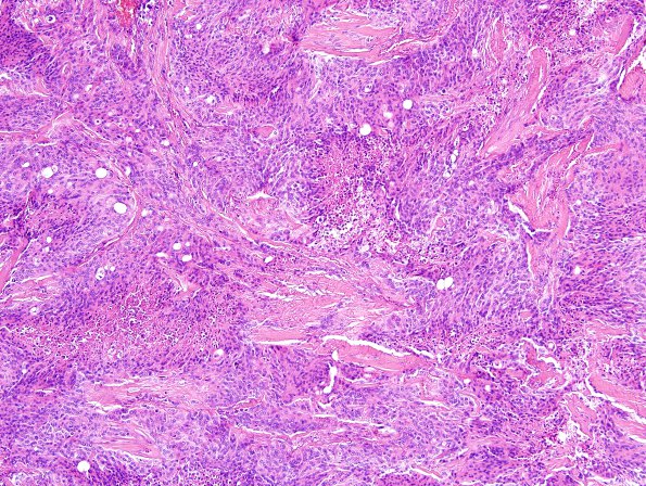 28A1 Meningioma, anaplastic (Case 28) H&E 2.jpg