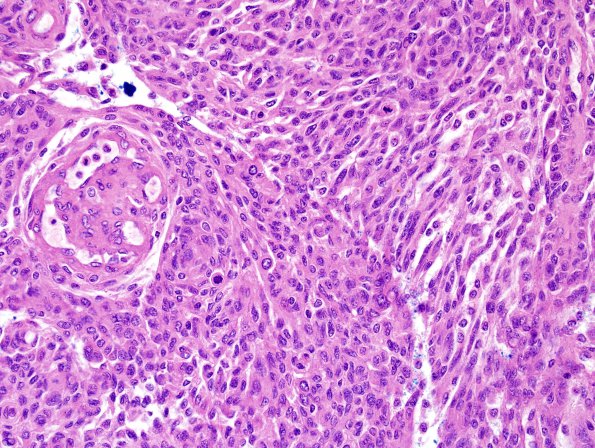 28A2 Meningioma, anaplastic (Case 28) H&E 6.jpg