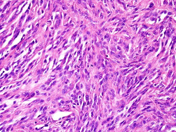 28A3 Meningioma, anaplastic (Case 28) H&E 3.jpg