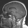 2A1 Meningioma, anaplastic (Case 2) T1 no C - Copy