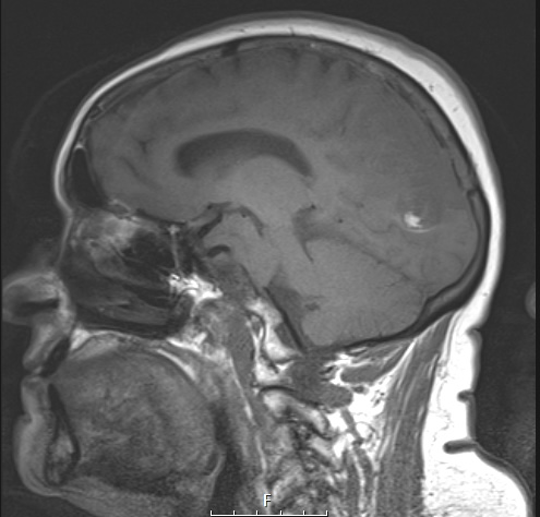 2A1 Meningioma, anaplastic (Case 2) T1 no C - Copy