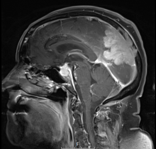 2A2 Meningioma, anaplastic (Case 2) T1W - Copy