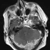 2A3 Meningioma, anaplastic (Case 2) T1 W 2 (2) - Copy