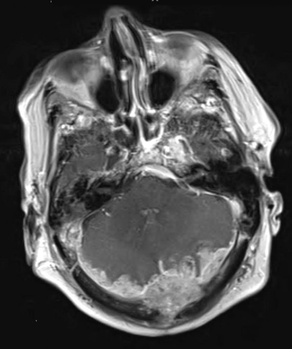 2A3 Meningioma, anaplastic (Case 2) T1 W 2 (2) - Copy