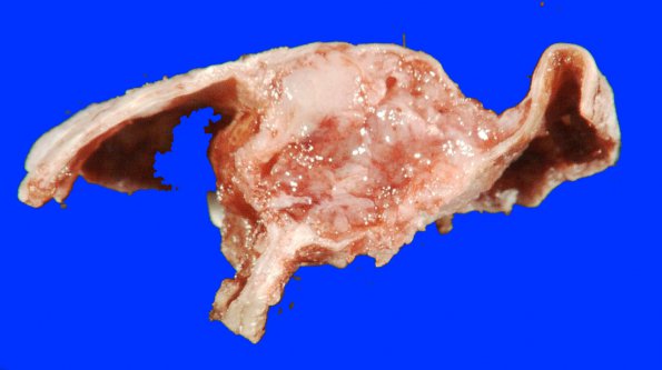 2B1 Meningioma, anaplastic (Case 2) Gross_8