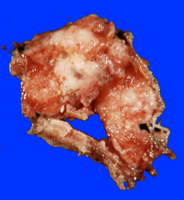 2B2 Meningioma, anaplastic (Case 2) Gross_5