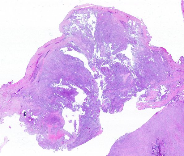 2C1 Meningioma, anaplastic (Case 2) 1 H&E HWM