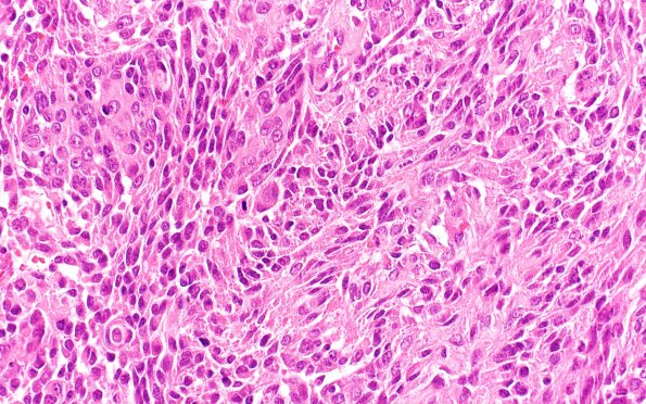 2C3 Meningioma, anaplastic (Case 2) 1 H&E island right edge 40X