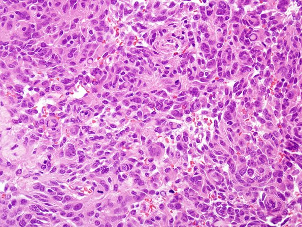 2C4 Meningioma, anaplastic (Case 2) H&E 9