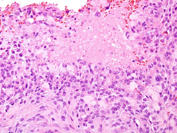 2C5 Meningioma, anaplastic (Case 2) H&E 3