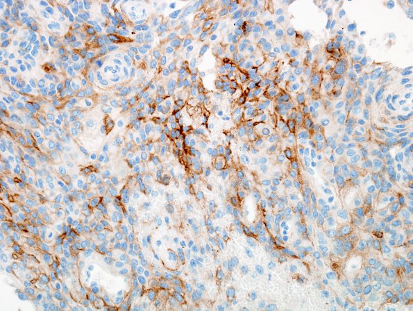 2D2 Meningioma, anaplastic (Case 2) EMA 1