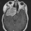 3A1 Meningioma, anaplastic (Case 3) T1 W1 - Copy