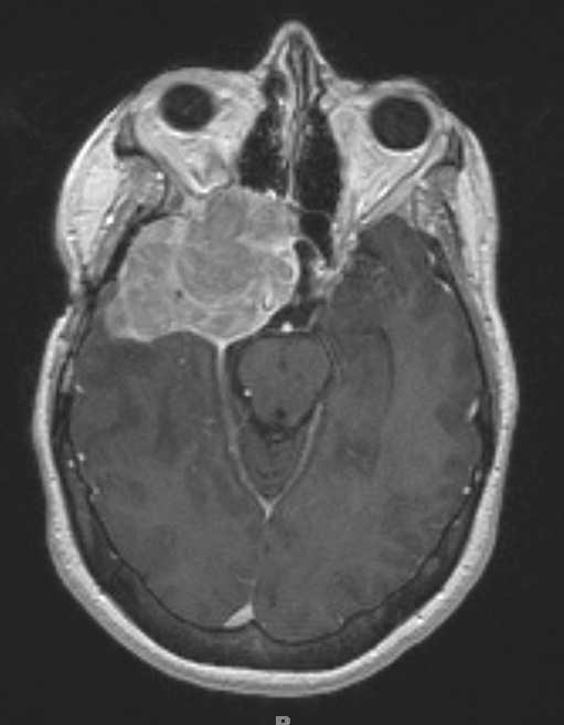 3A1 Meningioma, anaplastic (Case 3) T1 W1 - Copy