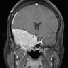 3A2 Meningioma, anaplastic (Case 3) T1 W3 - Copy