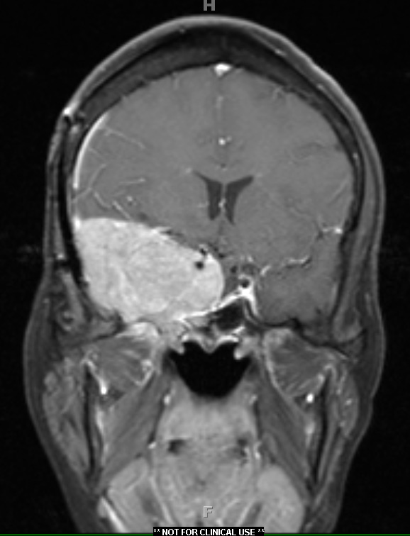 3A2 Meningioma, anaplastic (Case 3) T1 W3 - Copy