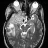 3A3 Meningioma, anaplastic (Case 3) T2 W1 - Copy