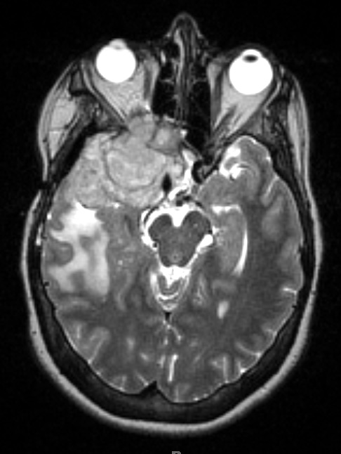 3A3 Meningioma, anaplastic (Case 3) T2 W1 - Copy