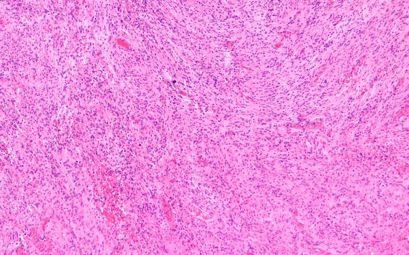 3B1 Meningioma, anaplastic (Case 3) 10X