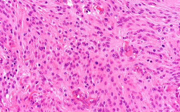 3B2 Meningioma, anaplastic (Case 3) 40X