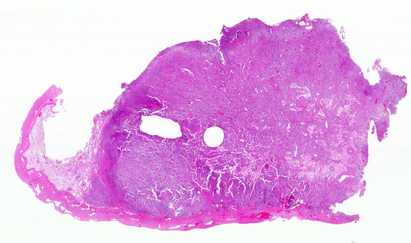 4B1 Meningioma, Anaplastic (Case 4) H&E WM