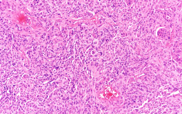 4B2 Meningioma, Anaplastic (Case 4) B3 H&E 20X