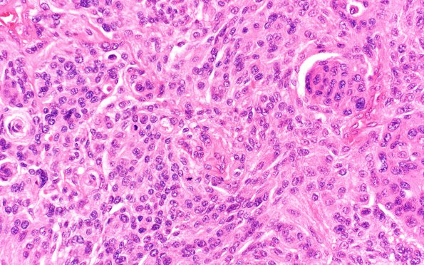 4B3 Meningioma, Anaplastic (Case 4) B3 H&E 40X