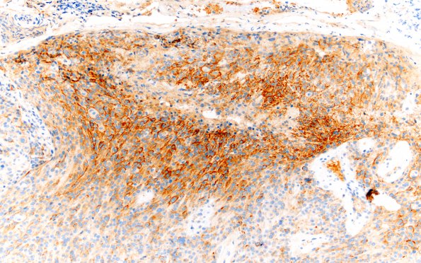 4C Meningioma, Anaplastic (Case 4) EMA 20X