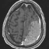 5A1 Meningioma, anaplastic (Case 5) T1 POST 1 - Copy