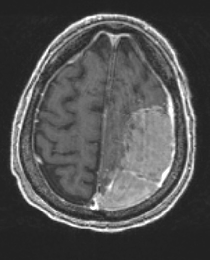 5A1 Meningioma, anaplastic (Case 5) T1 POST 1 - Copy