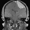 5A2 Meningioma, anaplastic (Case 5) T1 POST 2 - Copy