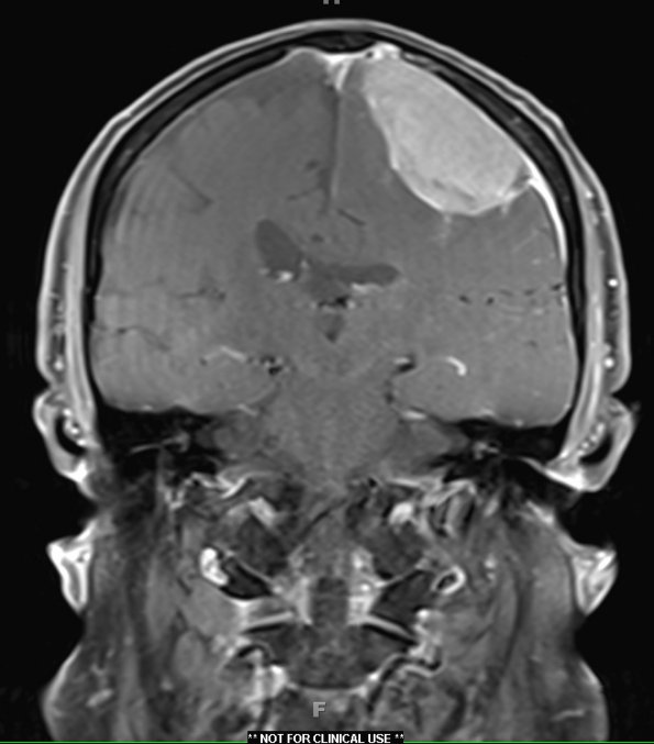 5A2 Meningioma, anaplastic (Case 5) T1 POST 2 - Copy