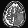 5A3 Meningioma, anaplastic (Case 5) T2 W1 - Copy