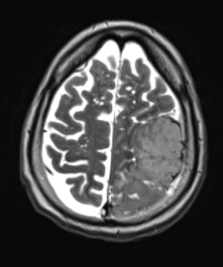 5A3 Meningioma, anaplastic (Case 5) T2 W1 - Copy