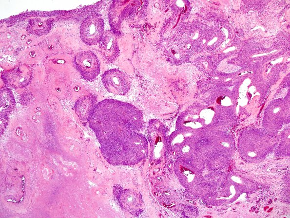 5B1 Meningioma, anaplastic (Case 5) H&E 5