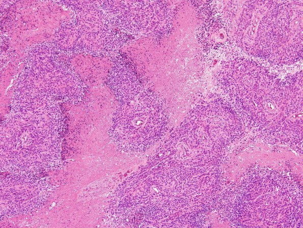 5B2 Meningioma, anaplastic (Case 5) H&E 9