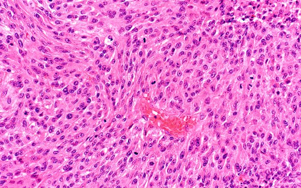 5B3 Meningioma, anaplastic (Case 5) A4 EMA 40X 2