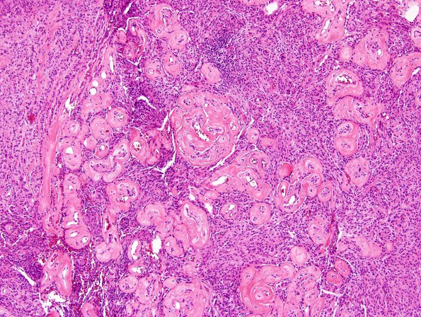 5B4 Meningioma, anaplastic (Case 5) H&E 8