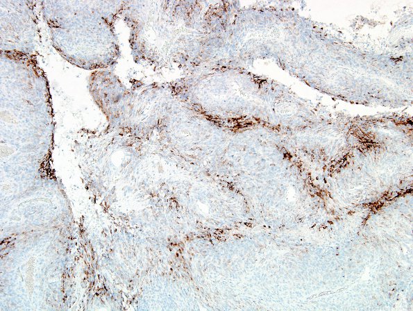 5C1 Meningioma, anaplastic (Case 5) EMA 1