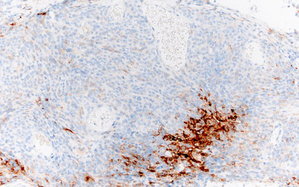 5C2 Meningioma, anaplastic (Case 5) A4 EMA 20X