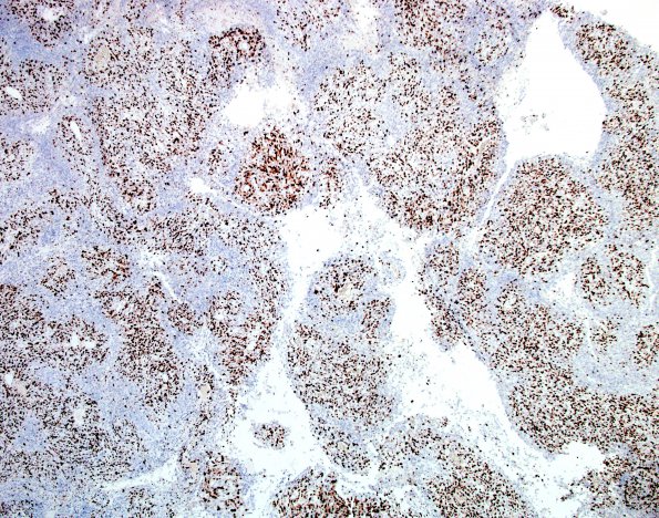 5E Meningioma, anaplastic (Case 5)