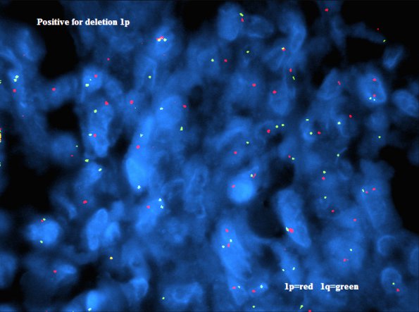 5F1 Meningioma, anaplastic (Case 5) 1p - Copy