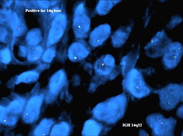 5F2 Meningioma, anaplastic (Case 5) 14q - Copy