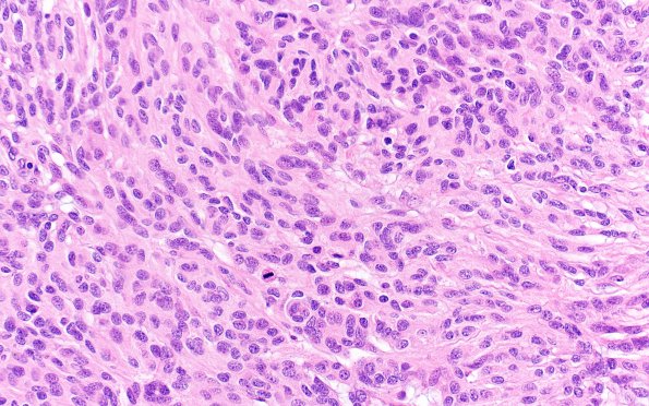 6A1 Meningioma, anaplastic (Case 6) B3 H&E40X