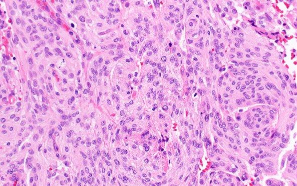 6A2 Meningioma, anaplastic (Case 6) H&E 4